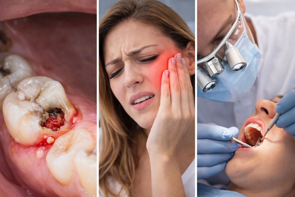 Infectie dentara Galati